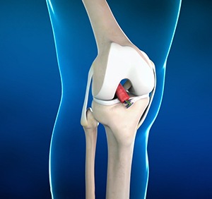 BEAR Implant for ACL Reconstruction