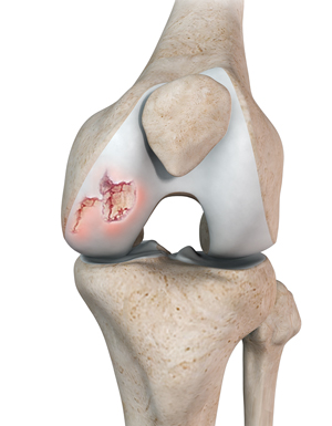 Articular Cartilage Defects