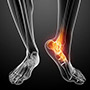 Fifth Metatarsal Fractures