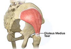 Arthroscopic Gluteus Medius Tendon Repair