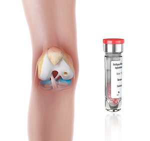 Matrix Induced Autologous Chondrocyte Implantation