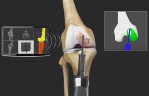 Mako SmartRobotics for Partial Knee Replacement