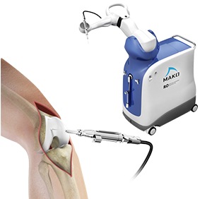 Mako SmartRobotics for Total Knee Replacement