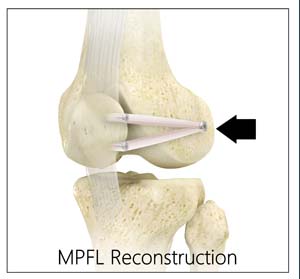 MCL Reconstruction