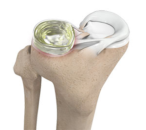 Meniscus Replacement