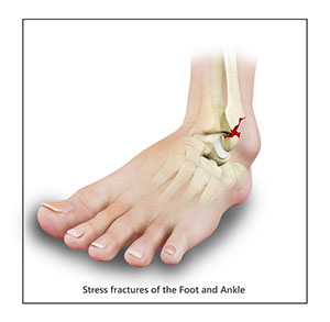 Stress Fractures of Foot and Ankle