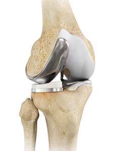 Unicompartmental/Partial Knee Replacement